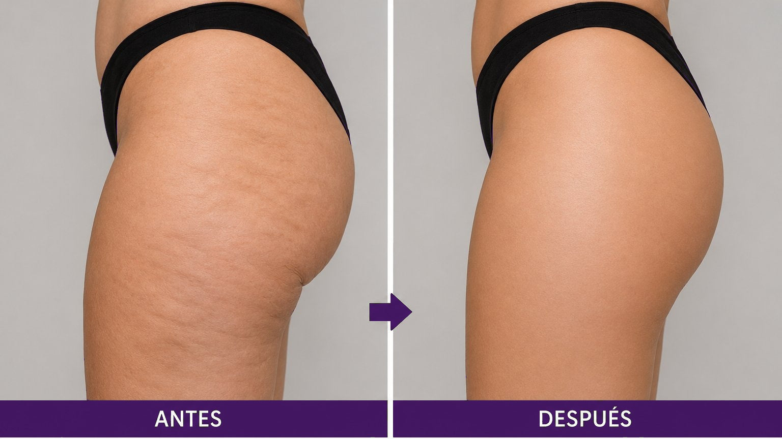 Muslo - Reducción de celulitis