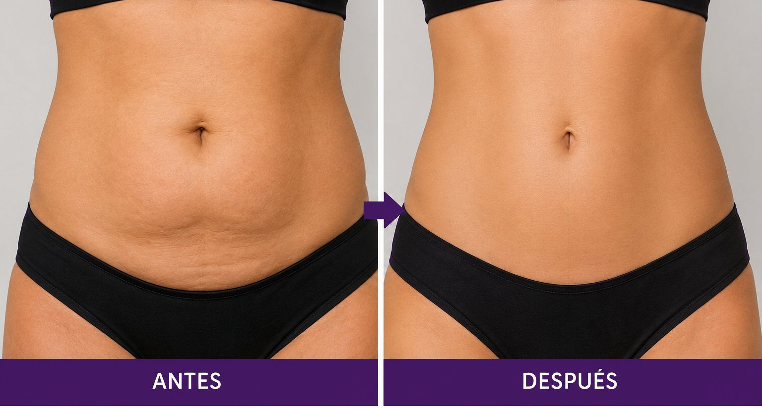 Abdomen - Reducción de celulitis