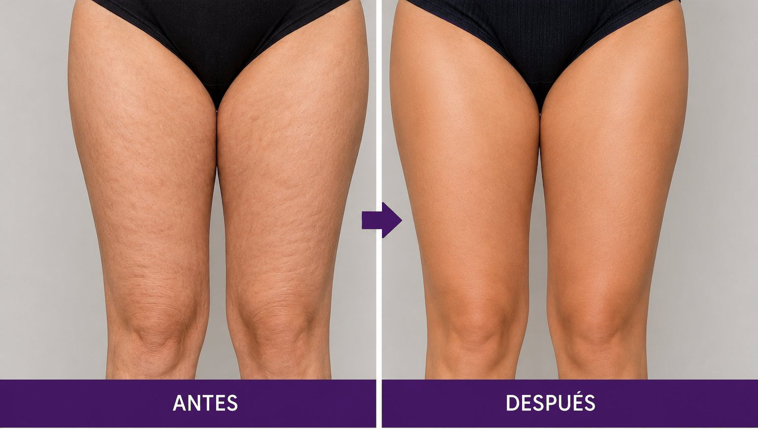 Muslos frontal - Reducción de celulitis